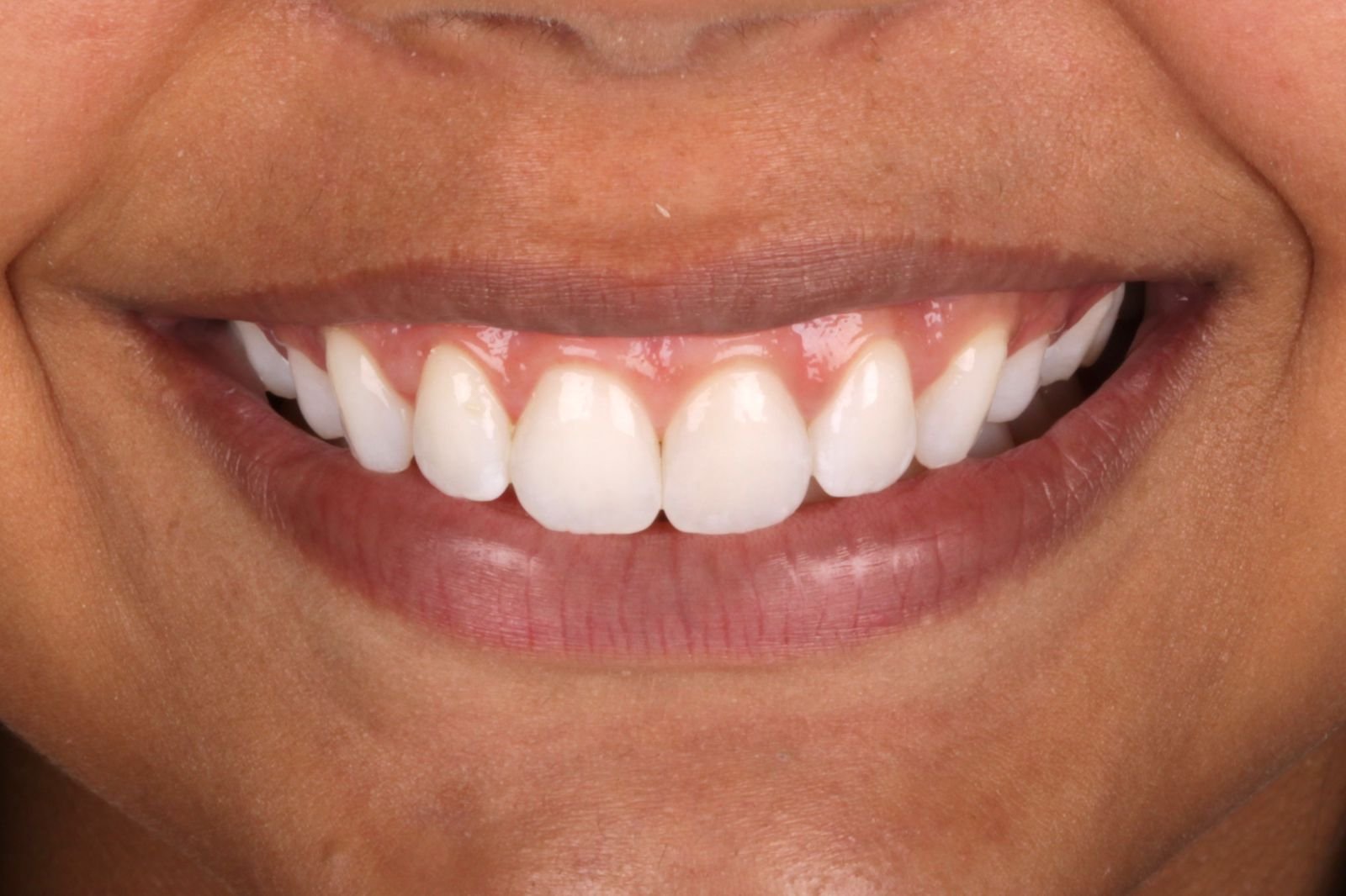 Pós clareamento dental na Voyah Clinic em Salvador