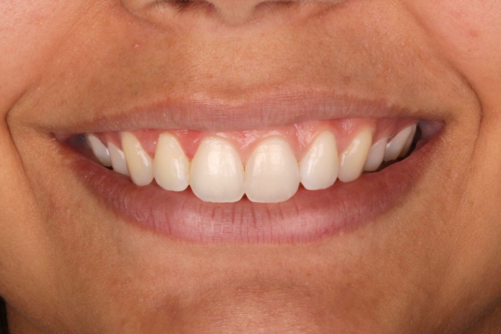 Clareamento dental profissional com comparação do sorriso antes