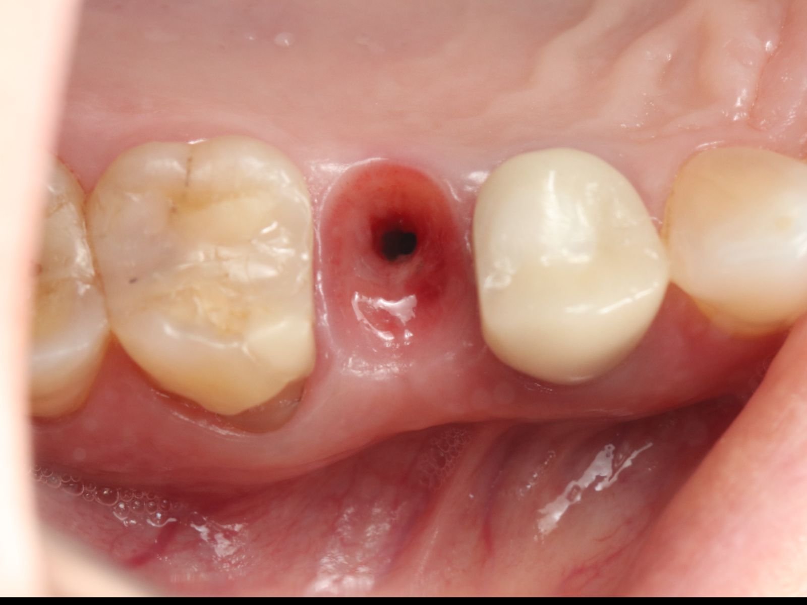 Implante dentario feito na voyah Clinic em Salvador Bahia