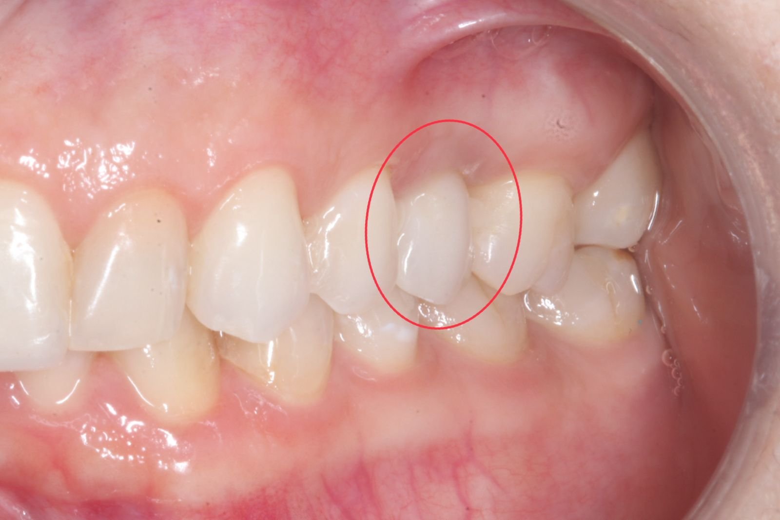 Implante dentario feito na voyah Clinic em Salvador Bahia