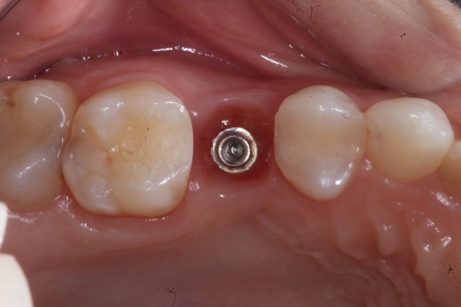 Implante dentario na Voyah Clinic
