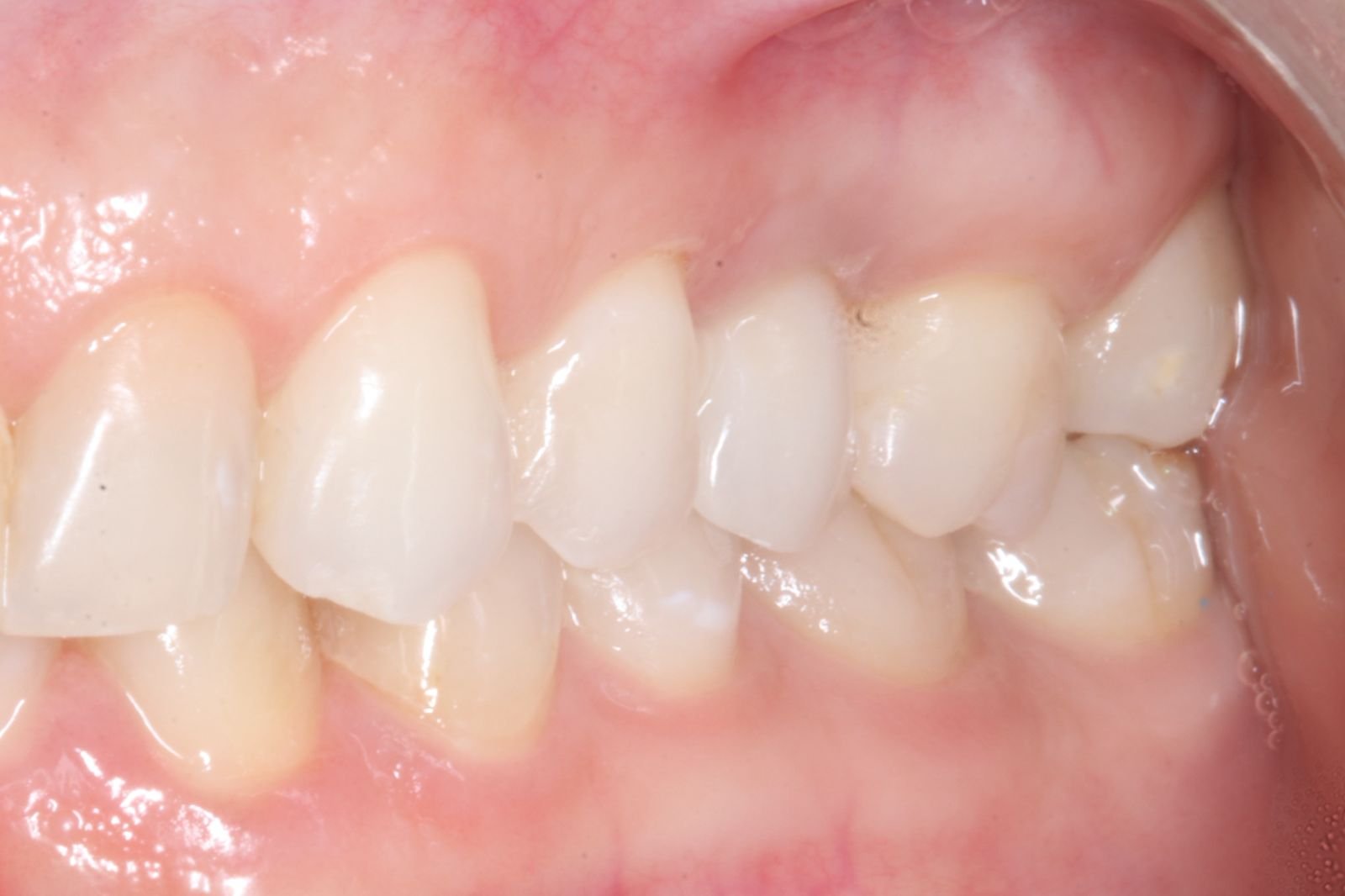 Implante dentario feito na voyah Clinic em Salvador Bahia