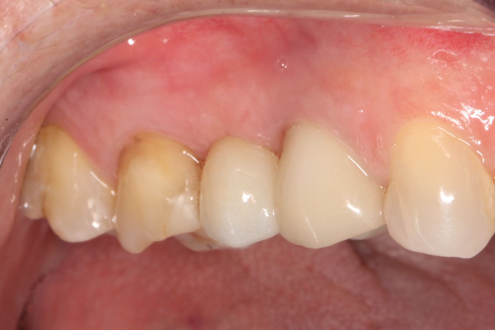 Implante dentario na Voyah Clinic