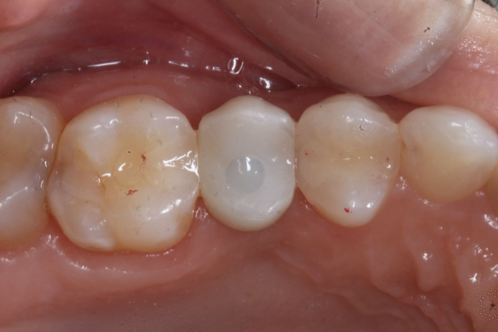 Implante dentario na Voyah Clinic
