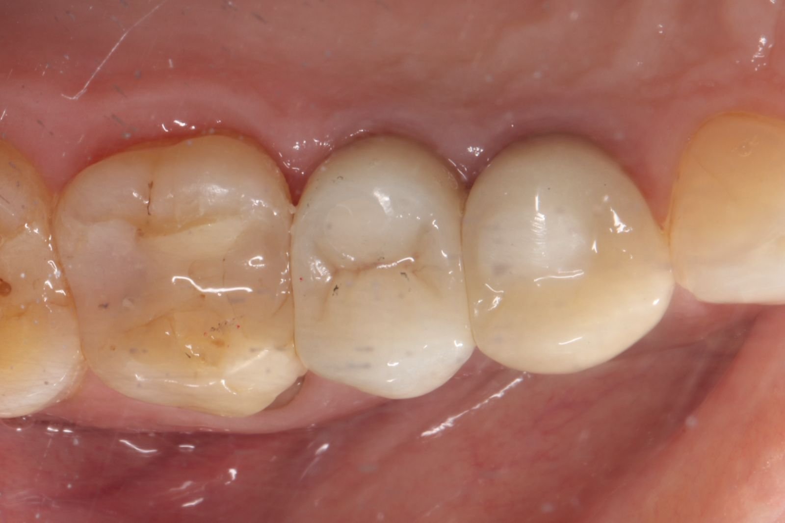 Implante dentario feito na voyah Clinic em Salvador Bahia