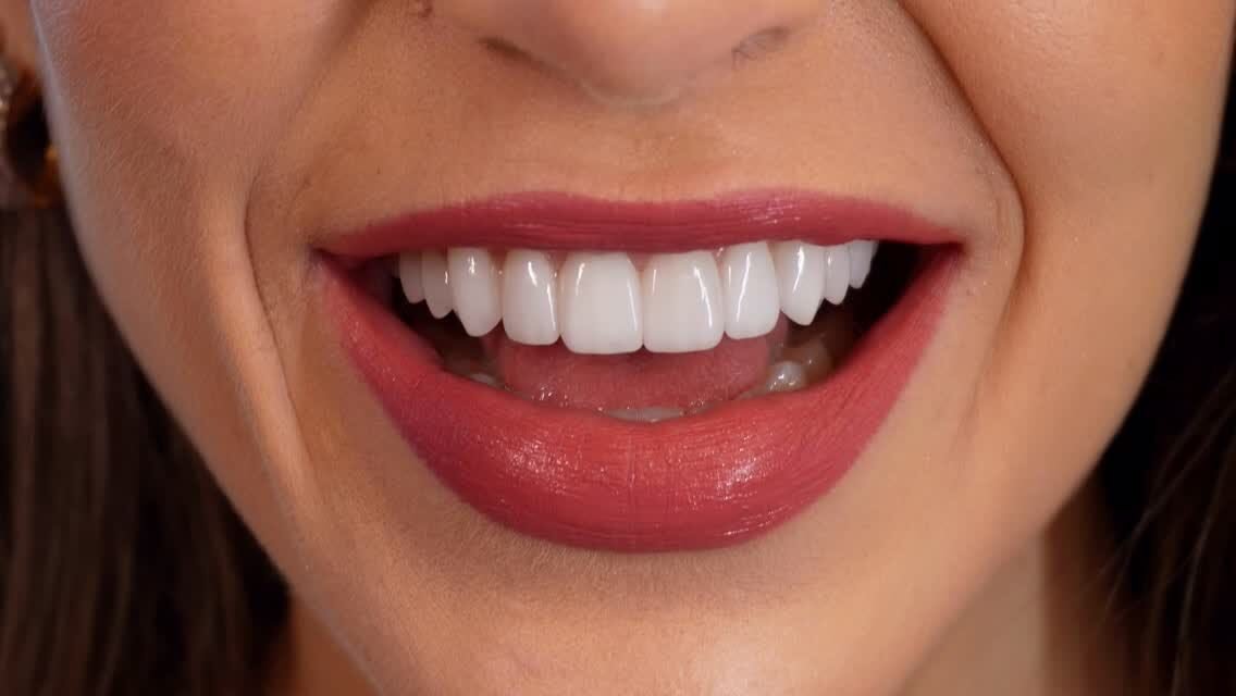 Lente de contato dental colocada para transformar o sorriso